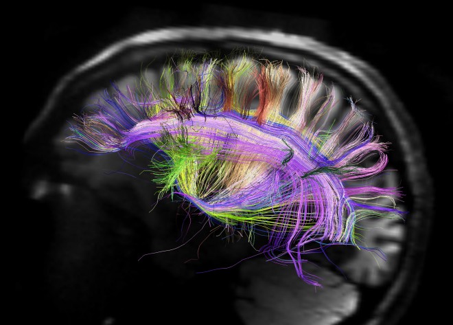 Imagen: M. D. Van Wedeen, Martinos Center and Dept. of Radiology/Massachusetts General Hospital/Harvard U. Medical School
